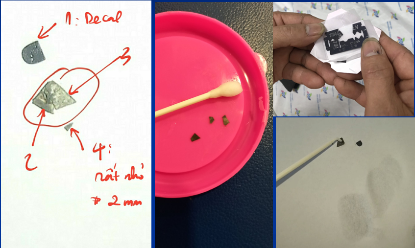 Các mảnh vụn dao lam được tìm thấy trong phân sau khi trẻ đi tiêu Các mảnh vụn dao lam được tìm thấy trong phân sau khi trẻ đi tiêu