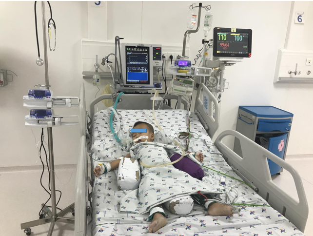 Trẻ 20 tháng tuổi, hóc xương heo đường thở gây suy hô hấp nặng, được nội soi cấp cứu lấy dị vật và được tiếp tục điều trị tại Khoa Hồi sức ngoại.